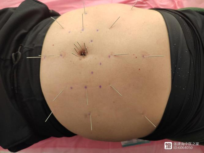 腹部减肥针灸视频下载