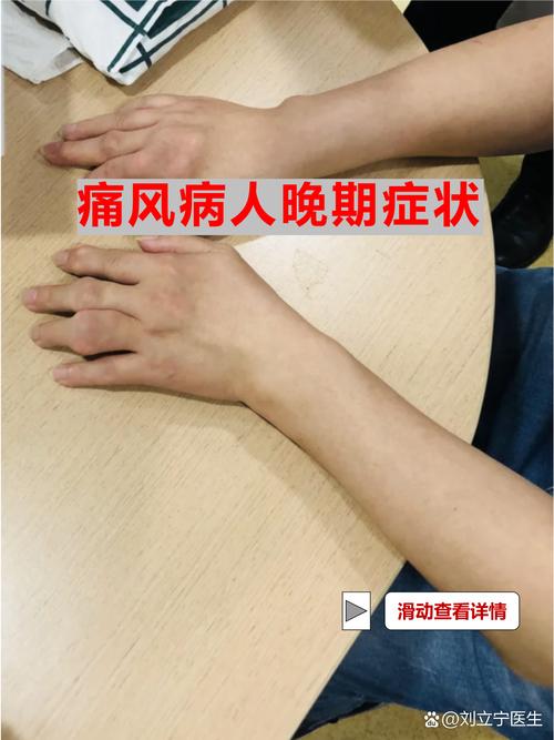 美国有多少人得痛风病