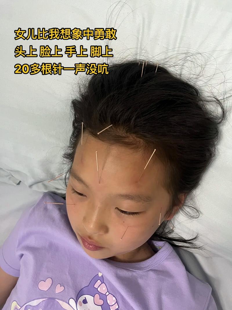 多动症针灸治疗扎哪里