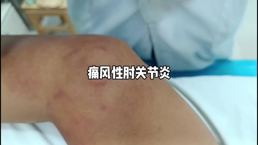 痛风胳膊肘肿了怎么办