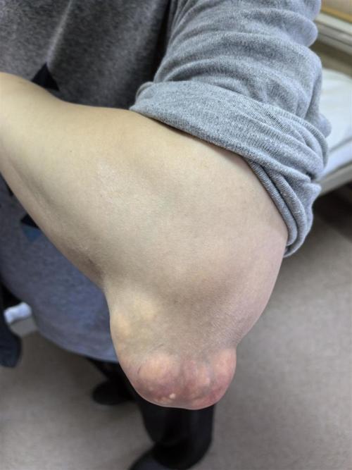 痛风胳膊肘肿了怎么办