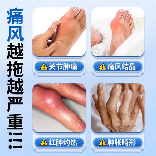 痛风胳膊肘肿了怎么办