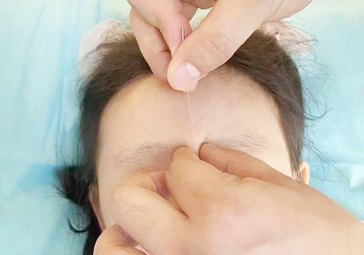 中华医药 近视 针灸