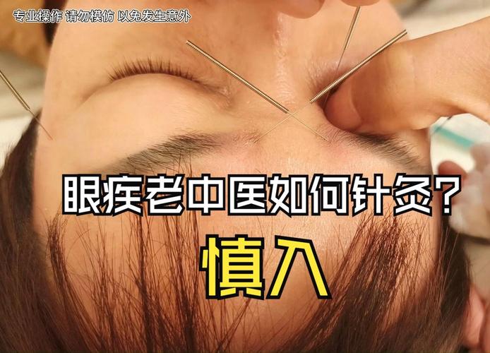 中华医药 近视 针灸