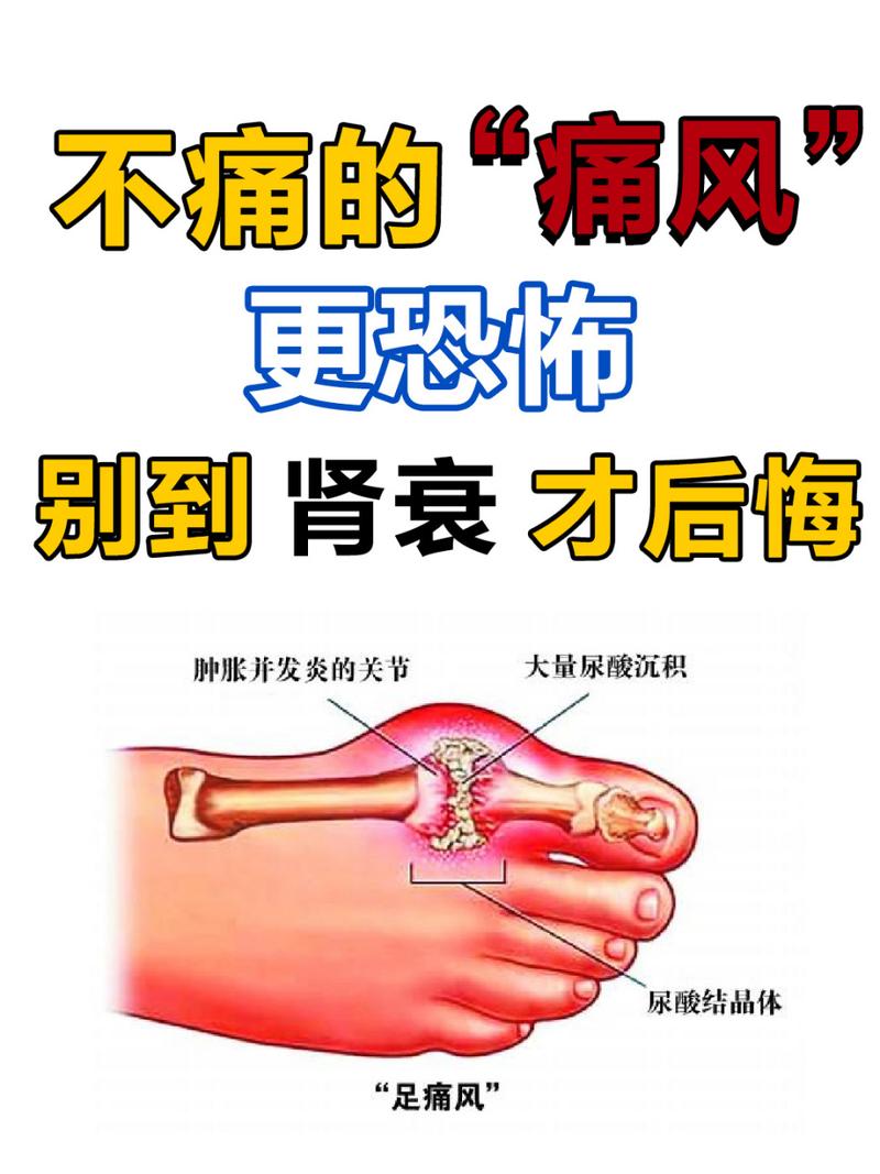 痛风有十年不发作的吗
