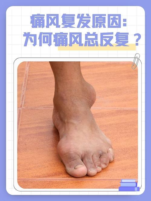 类风湿关节炎是痛风吗