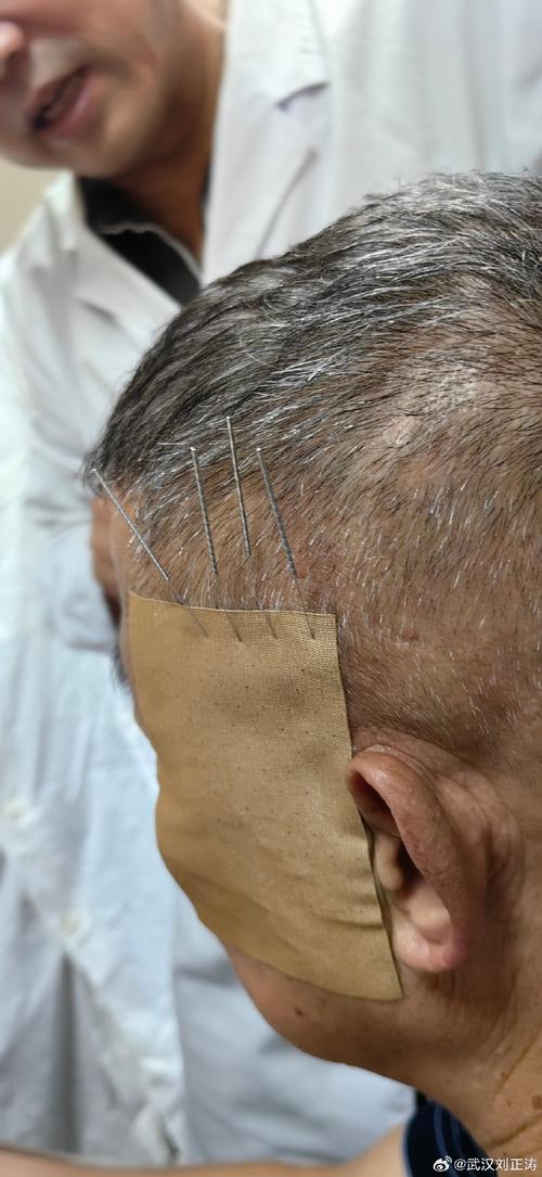 针灸能治三叉神经痛吗