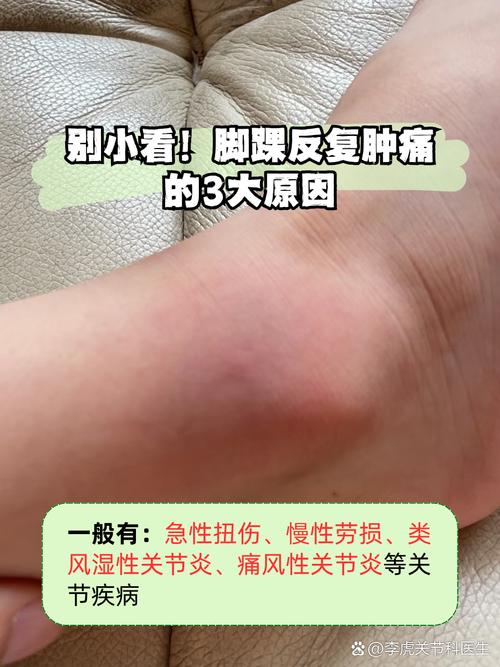 崴脚能诱发痛风发作么