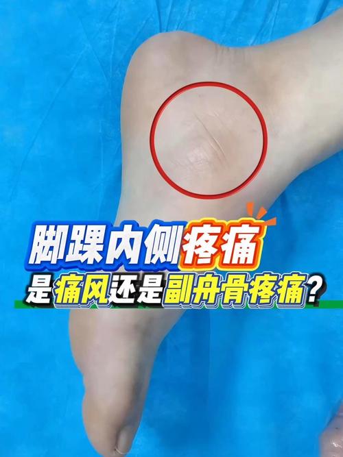 一只脚脖子疼是痛风吗