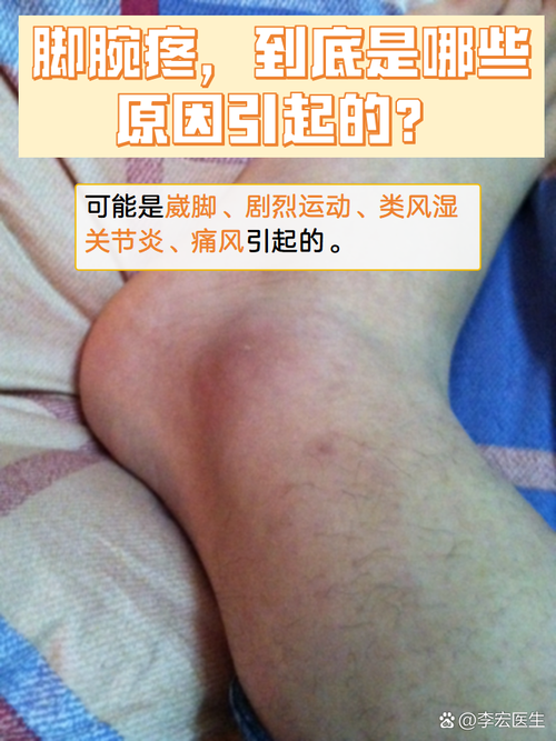 一只脚脖子疼是痛风吗