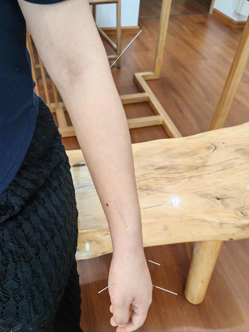 针灸治风湿性关节炎吗