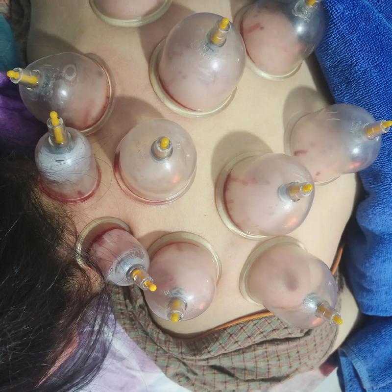 拔罐和针灸能一起做吗