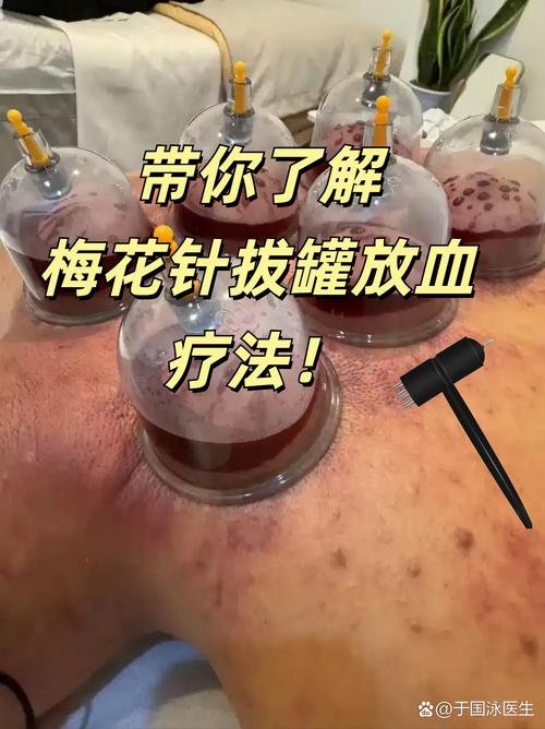 拔罐和针灸能一起做吗