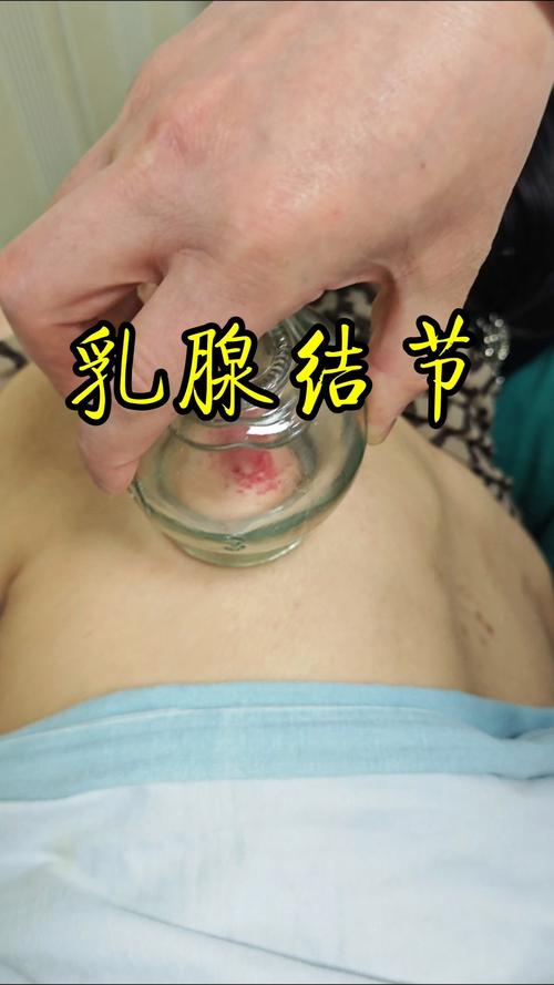 乳腺增生可不可以针灸
