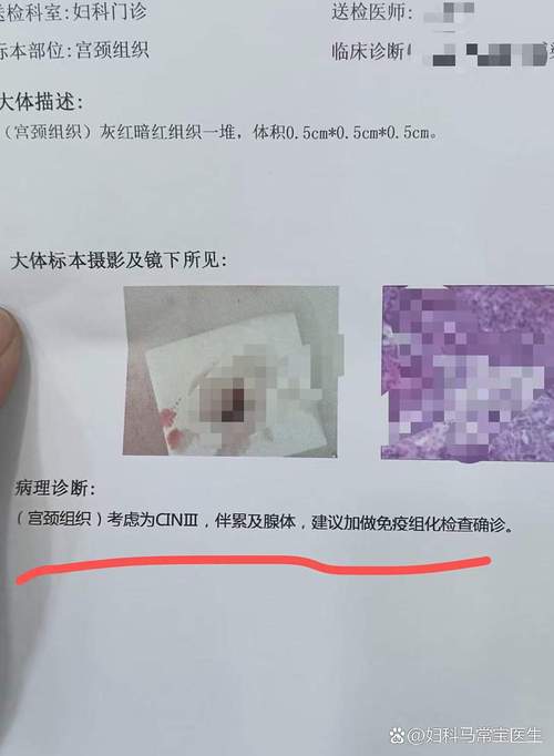 cin3锥切后几年后安全