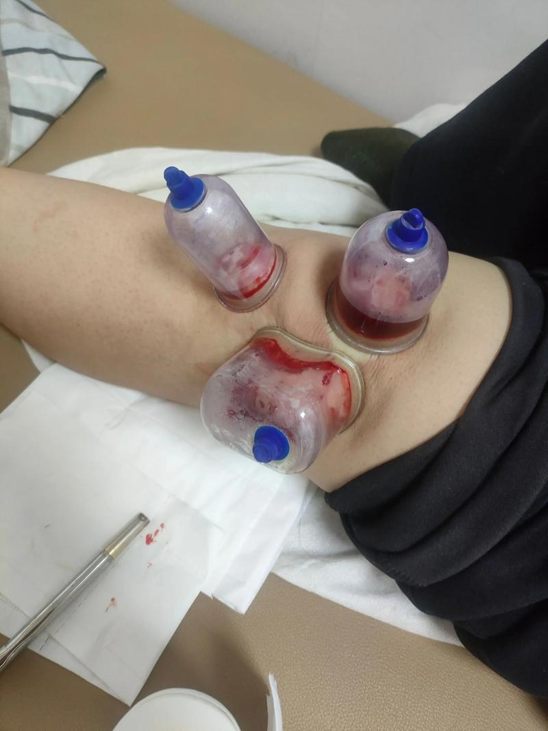 针灸拔罐治股骨头坏死