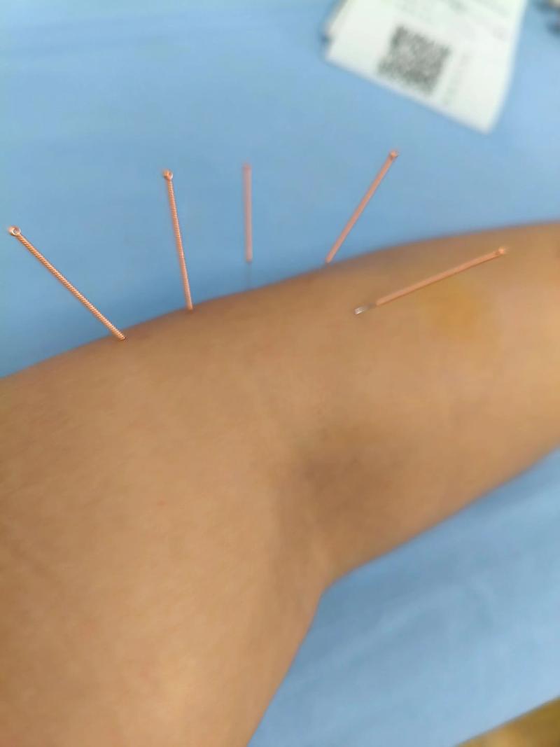 手指关节痛的针灸疗法