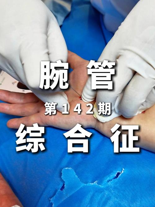 腕管综合症针灸有用吗