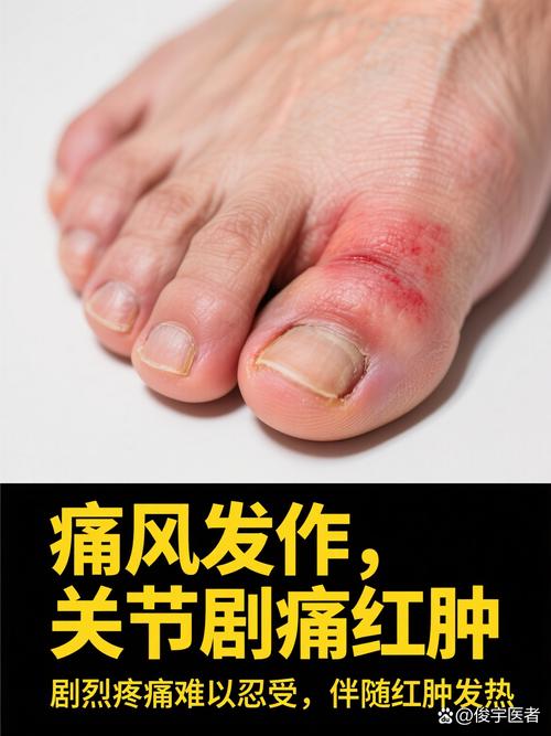 痛风发作会引起头痛么