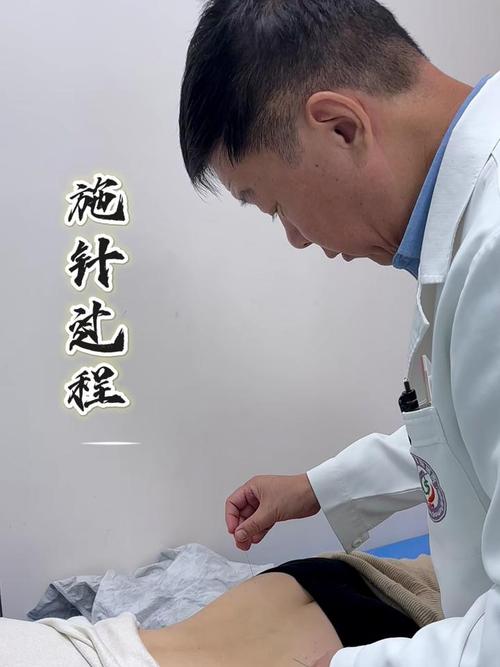 腰间盘突出针灸埋线法