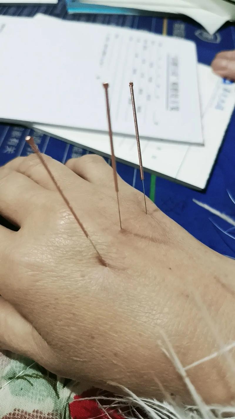 腰间盘突出针灸埋线法