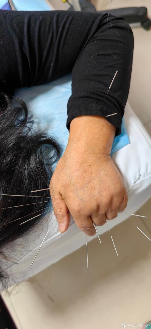 更年期综合征针灸治疗