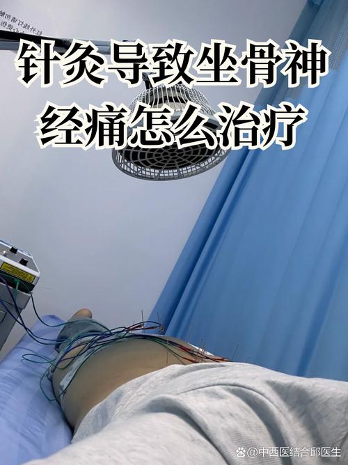 针灸会扎伤坐骨神经吗