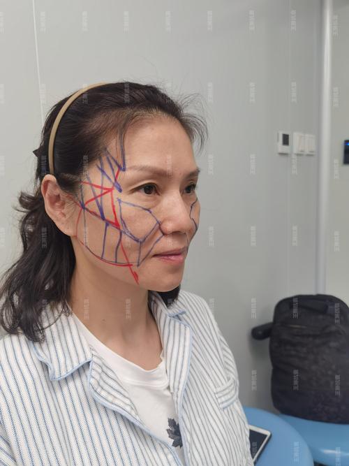 目前最安全的面部提升手术