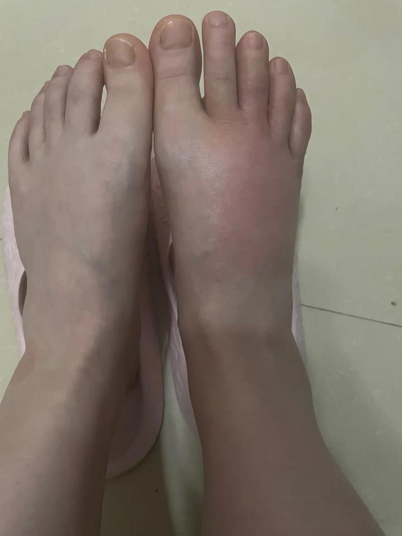 毕节四通医院治脚痛风