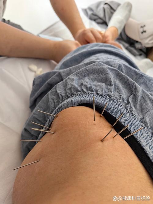针灸对股骨头坏死疗效