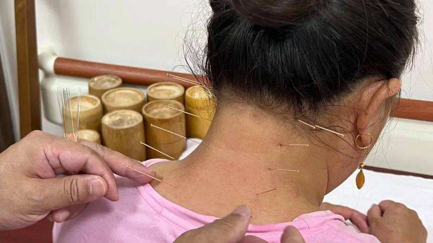 针灸治疗颈椎骨质增生