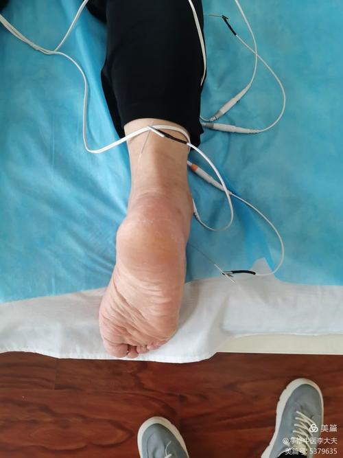 针灸治疗脑膜炎后遗症