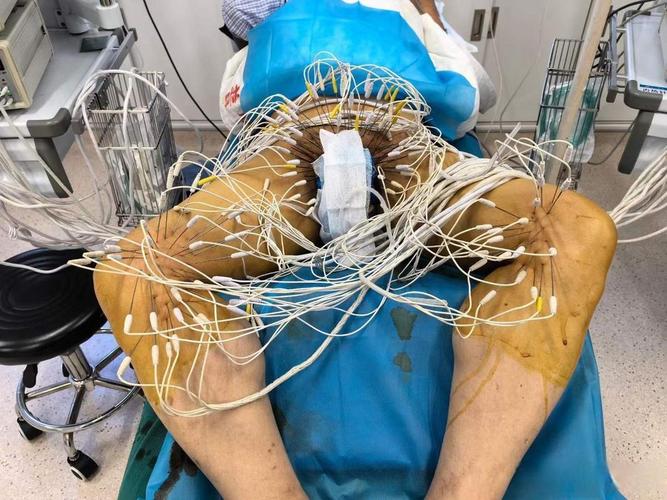 针灸治疗脑膜炎后遗症