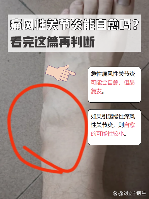 痛风会发生在膝关节吗