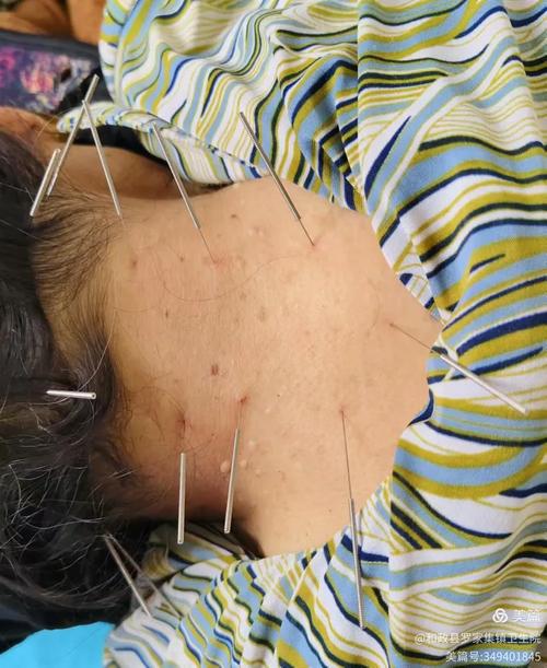 类风湿关节炎针灸穴位