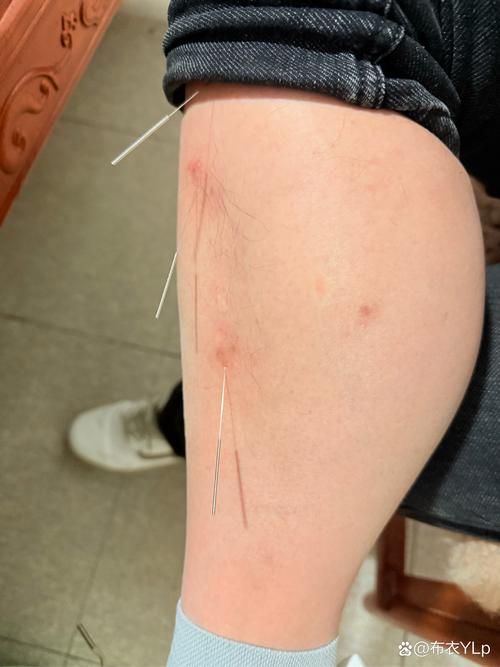 类风湿关节炎针灸穴位