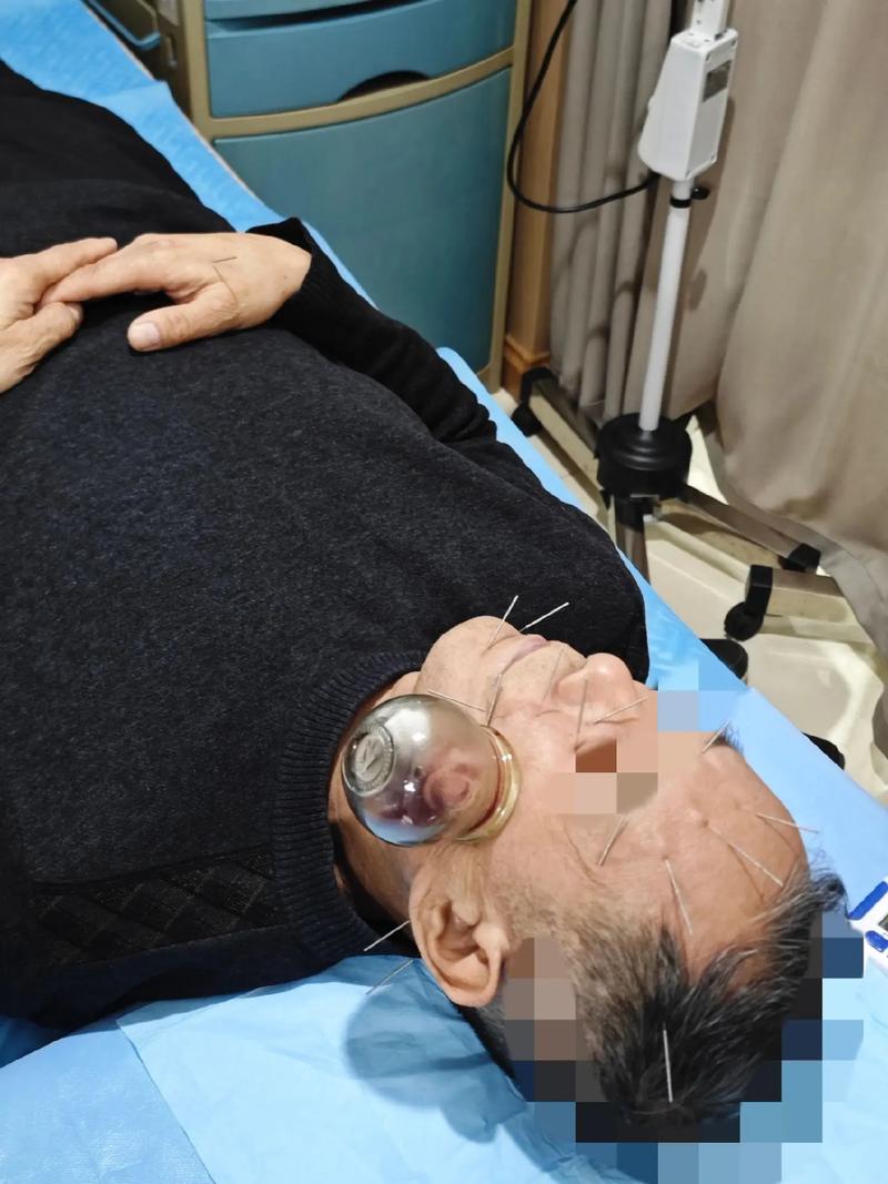 面神经炎可以不针灸吗