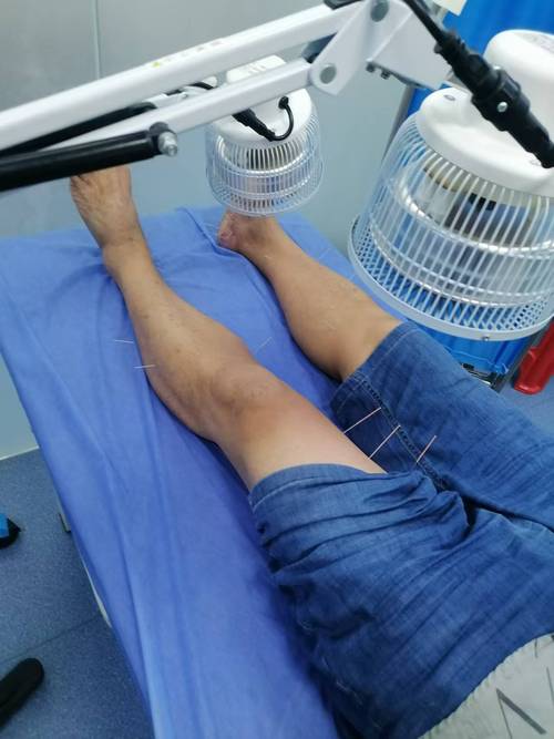 踝管综合征的针灸治疗