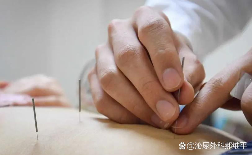 前列腺肥大的针灸疗法