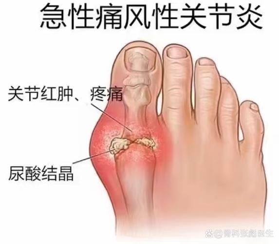 大脚趾关节痛风怎么办
