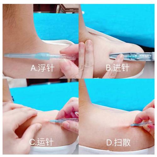 浮针和针灸有什么区别