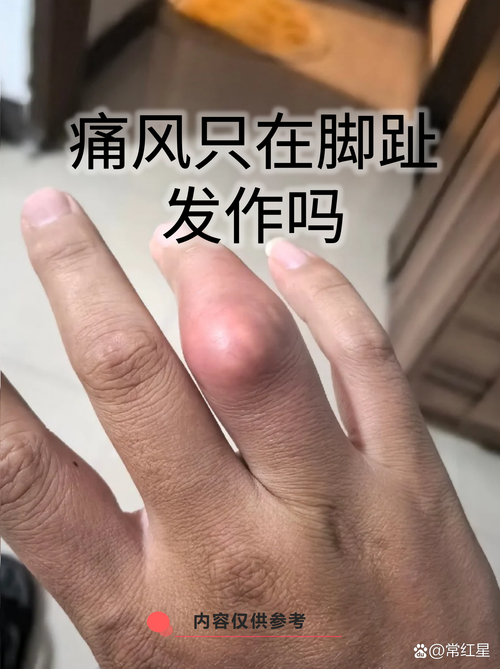 痛风大脚趾肿痛怎么办