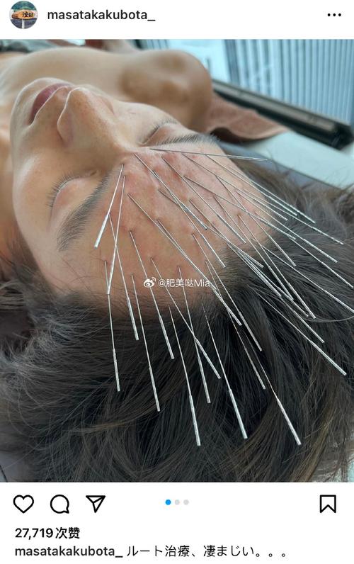 针灸治好了我的黑眼圈