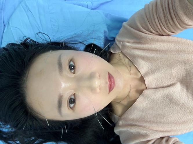 针灸治好了我的黑眼圈