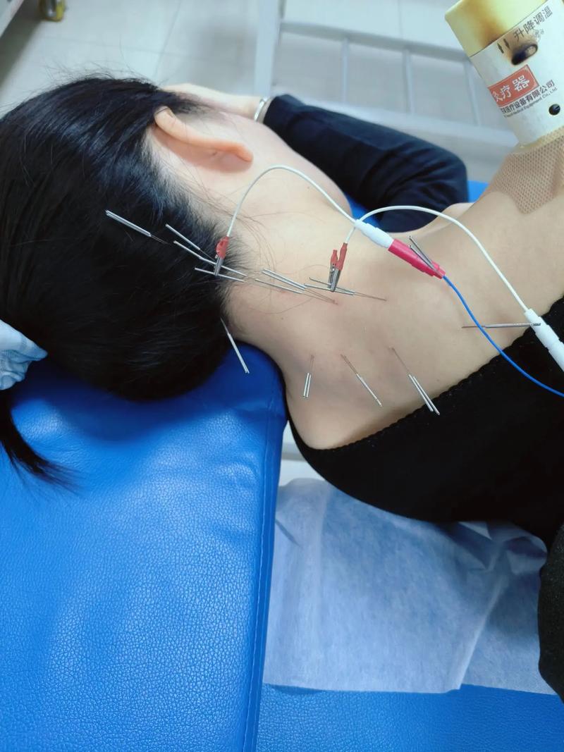 石家庄哪扎针灸扎的好