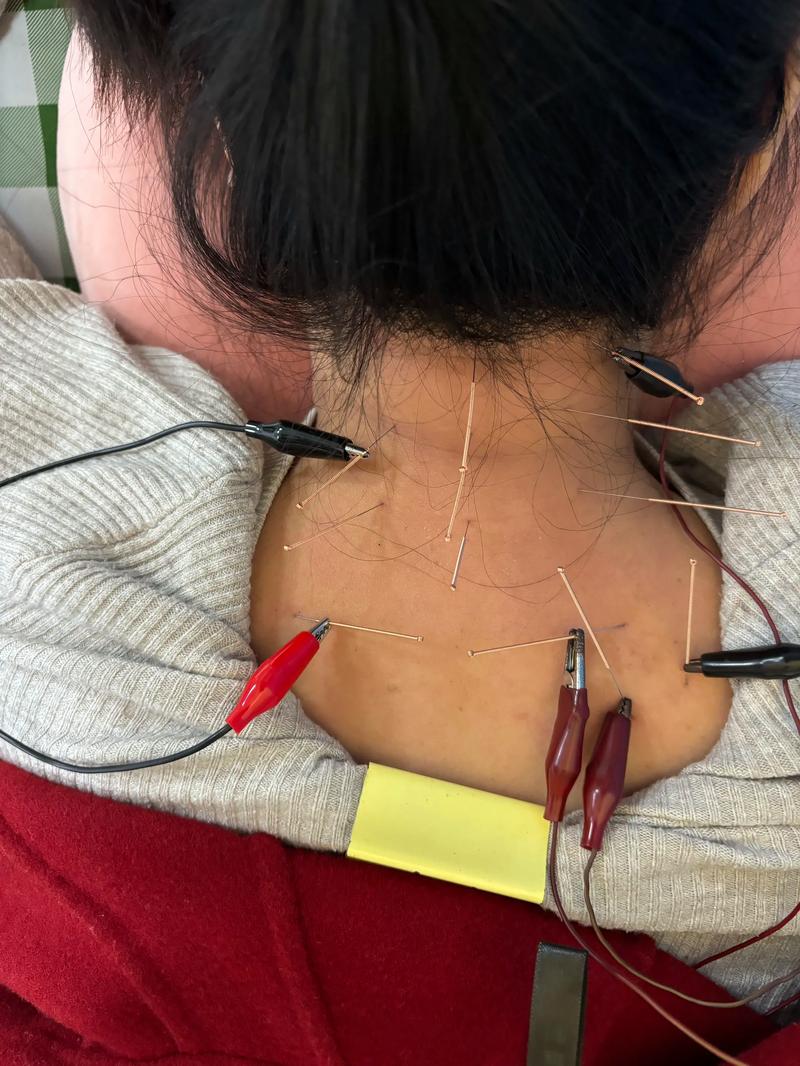 秦皇岛针灸多少钱一次