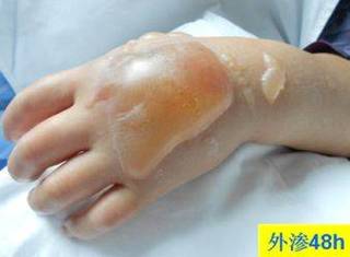 硫酸镁湿敷治疗痛风吗