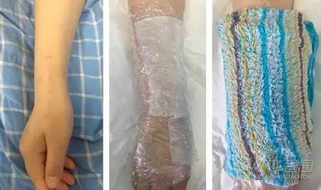 硫酸镁湿敷治疗痛风吗