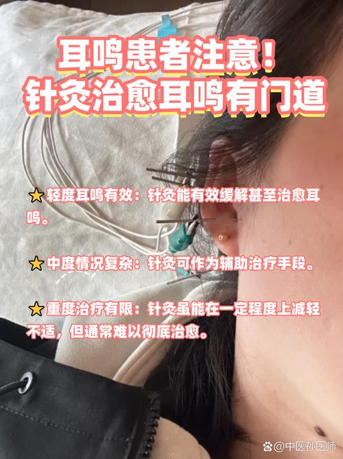 耳鸣针灸多长时间能好