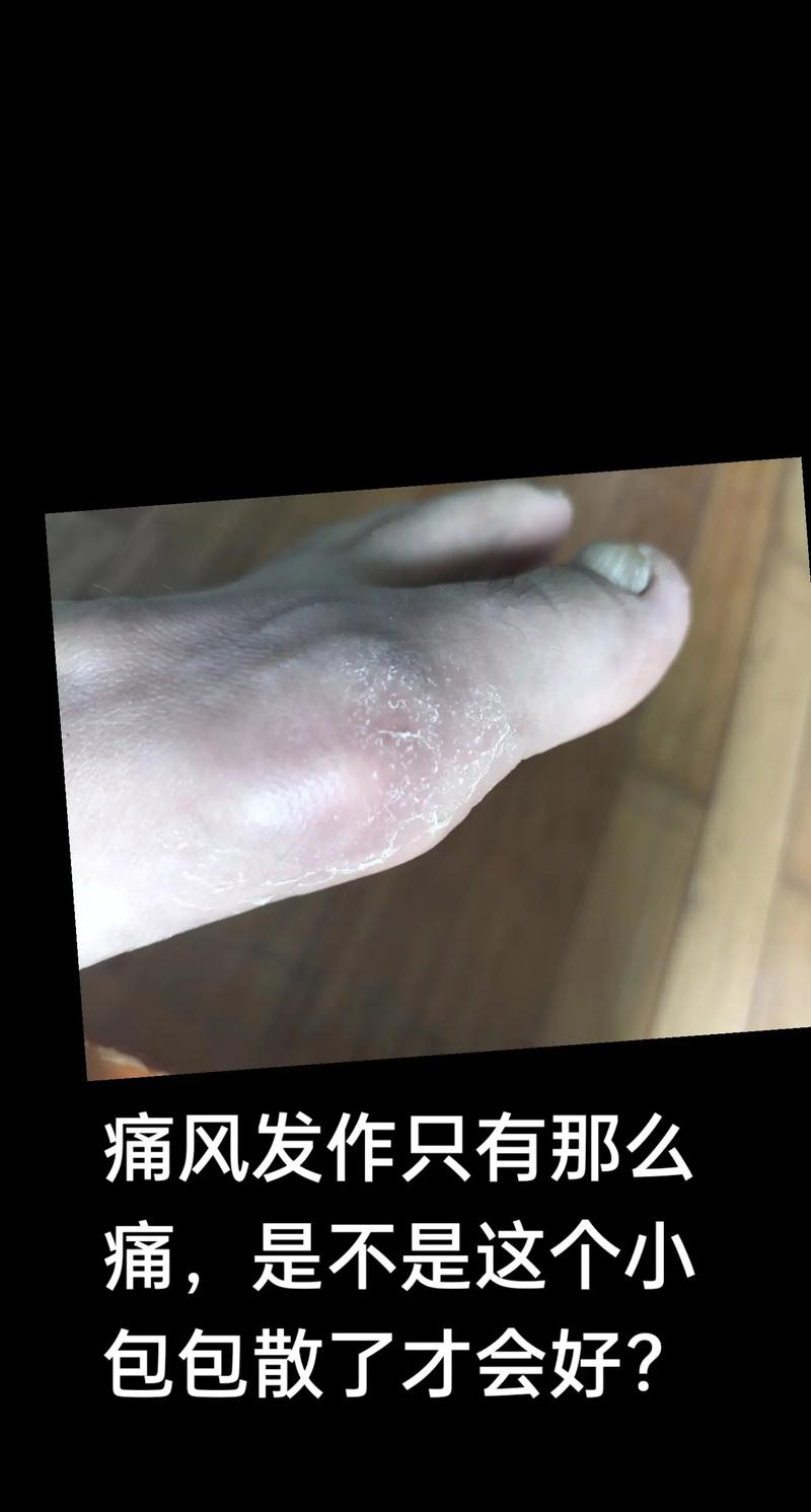 朱建福真的治好痛风么